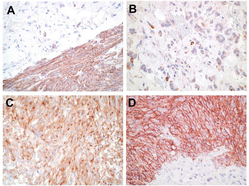 Background Documentation GIST 3.0.2.2 Figure 1. Patterns of KIT staining in gastrointestinal stromal tumor (GIST). A, Diffuse and strong immunoreactivity in a typical GIST.