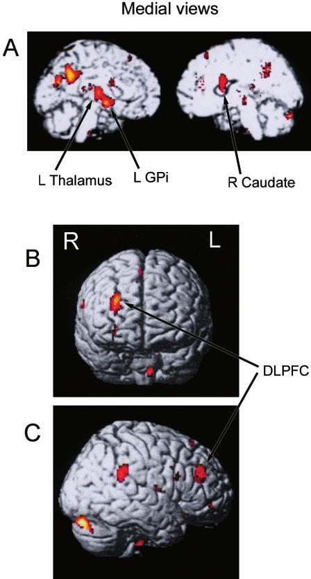 Fig. 1 Relative activations induced by left globus pallidus internus (GPi) stimulation during the rest condition in the six patients with primary generalized dystonia.