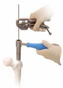 If the wire becomes lodged inside the nail, utilize the GUIDE WIRE GRIPPER and mallet to remove the guide wire from the nail. Fluoroscopy can assist you in guiding the wire past the fracture site.