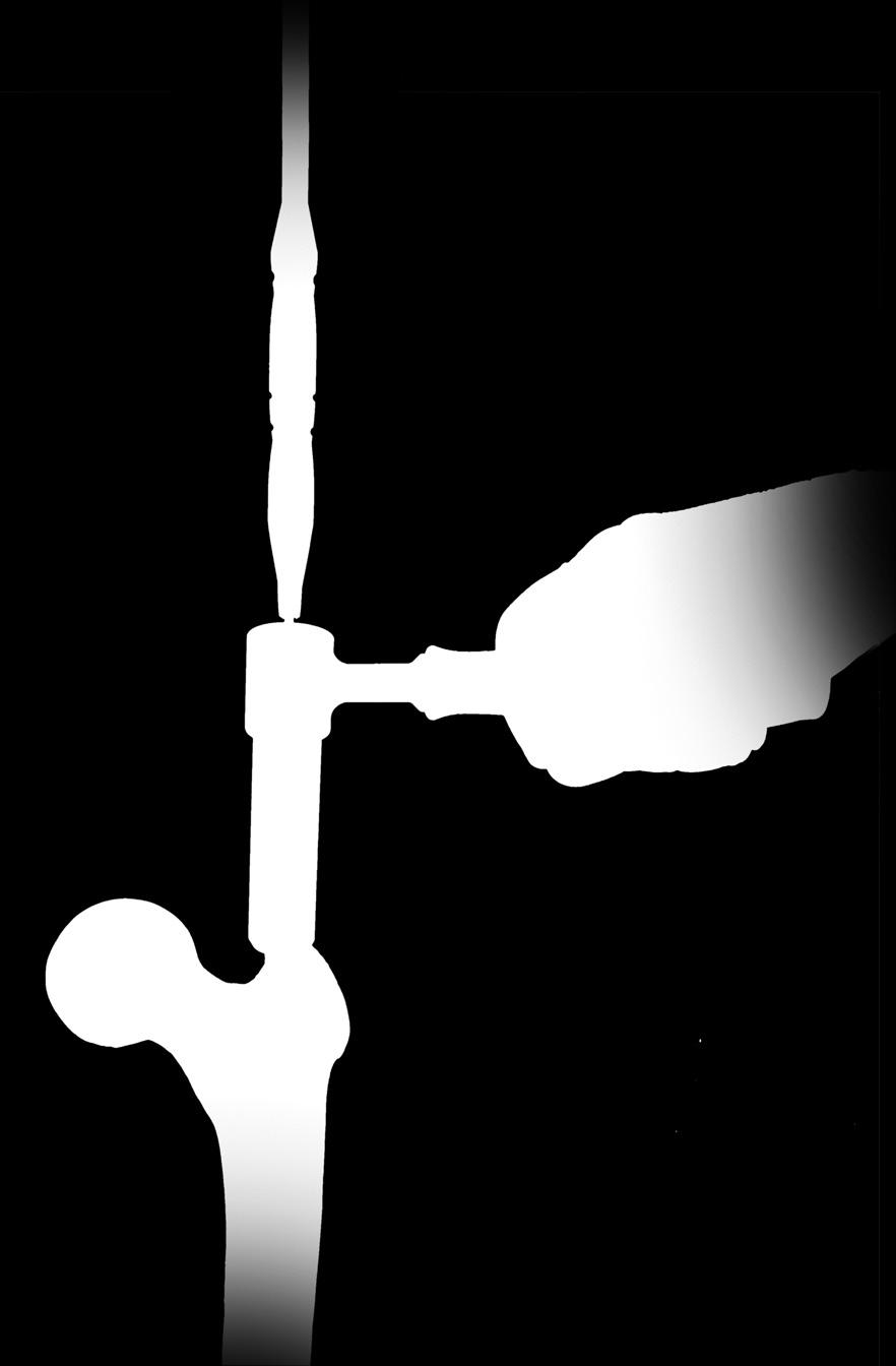 Care should be taken to keep the reamer in line with the shaft of the femur to avoid reaming through the cortex of the femur. Fig. 8 The 14.5mm TAPERED REAMER has three grooves on it.