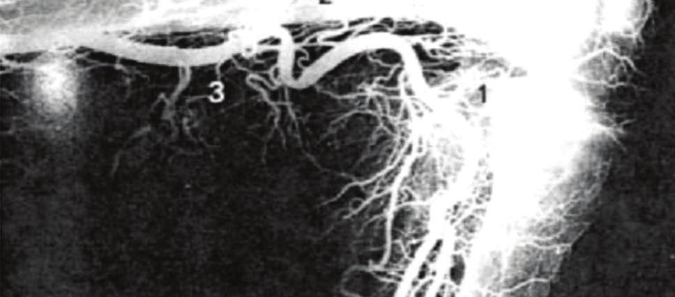 Our knowledge of what will and will not resolve itself, and how long it will take, is insufficient at present to allow extensive primary stenting with SX stents.