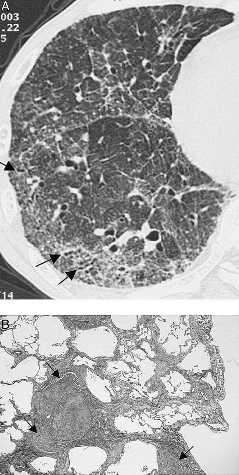 Figure 1. Top, A: CIP in an 82-year-old man with silicosis. This was the only case in which CT and pathologic diagnoses were contradictory.