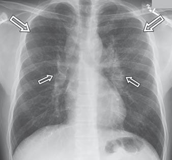 Nemec et al. C D Fig. 13 Pulmonary sarcoidosis.
