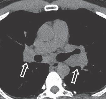 D, Coronal CT image of chest in different patient shows multiple calcified mediastinal and hilar lymph nodes (open arrow) as well as pulmonary opacities that have masslike appearance (solid arrows).