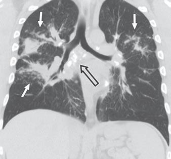 In bats hanging headfirst from tree branches or hollows, tuberculosis in the lung is observed in the lower lung zones, in contrast to upper lobe predominance in upright ambulating humans.