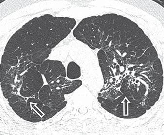 Upper Lobe Predominant Diseases of the Lung small nodules (1 5 mm) with a peribronchovascular distribution extending from the hilum to the periphery along with interlobular septal thickening (Fig.