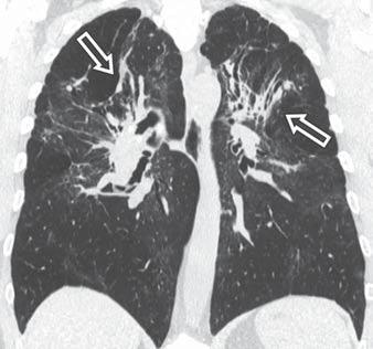 Other CT manifestations of sarcoidosis include ground-glass opacities and an alveolar pattern of airspace nodules and consolidation with air bronchograms (Fig. 13).