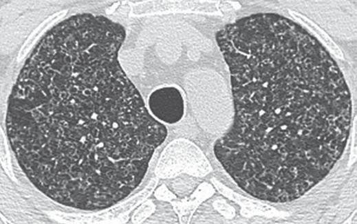 consolidations (Fig. 16). Hilar lymphadenopathy and pleural disease are infrequently seen.