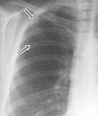 Nemec et al. Fig. 18 Metastatic pulmonary calcification. Posteroanterior chest radiograph shows multiple punctuate calcifications (arrows) in upper lung zones.