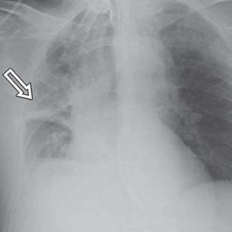Upper Lobe Predominant Diseases of the Lung the most common pulmonary diseases with upper lobe predominance on the basis of the physiologic background (Table 1).