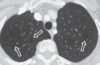 Nemec et al. Fig. 2 Centrilobular emphysema.