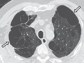 lobes. Centrilobular Emphysema Emphysema is a permanent abnormal enlargement of airspaces distal to terminal bronchioles that is accompanied by destruction of alveolar walls without fibrosis.