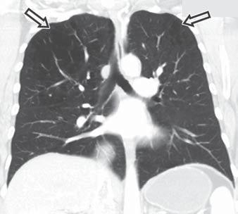 In contrast, panlobular emphysema primarily affects the lower lobes and is associated with α1- antitrypsin deficiency.