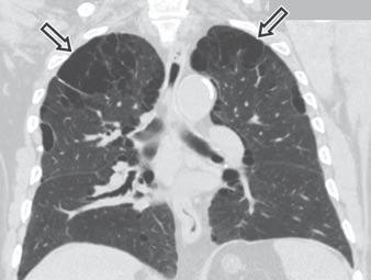 Radiographic signs include distortion of the vascular structures (focal absence or reduced caliber of pulmonary vessels), focal destruction of lung tissue, and increased lucency of the lung.