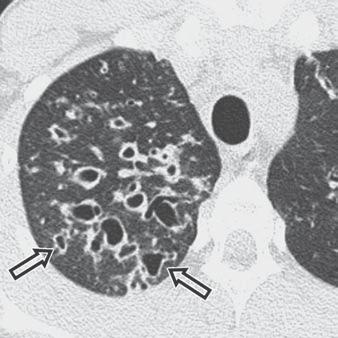 Upper Lobe Predominant Diseases of the Lung C D Fig. 4 Cystic fibrosis.