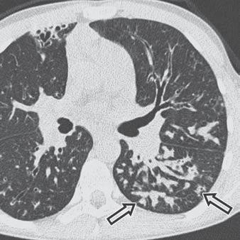 and C, Coronal () and transverse (C) CT images of chest show bilateral bronchiectasis and mucous impaction (arrows), primarily involving upper lung zones.