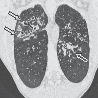 There is also typical bronchiectasis with mucous plugging (arrows).