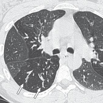 However, CT readily shows the walls of the individual cystic lesions, which differentiate these conditions from emphysema.