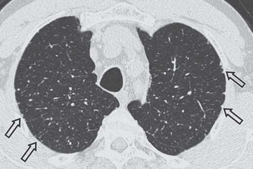 Nemec et al. Fig. 5 Silicosis. Transverse CT image of chest shows diffusely scattered centrilobular micronodules and multiple subpleural nodules (arrows) in upper lobes.