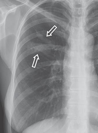 Upper Lobe Predominant Diseases of the Lung absent honeycombing.