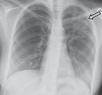 bronchial obstruction and mucoid impaction, such as carcinoid tumor,