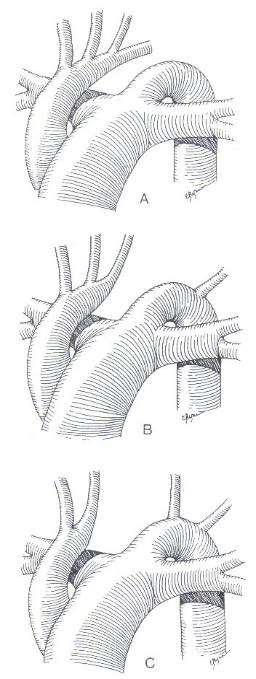 Interrupted Aortic Arch -Type A = After the subclavian artery, probably an extreme form of coarctation with obliteration of the lumen