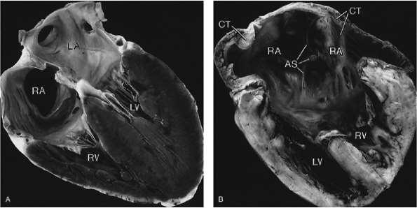 Example: Cardiac sidedness Situs solitus normal