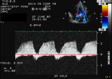 Doppler of the PDA (bidirectional shunt) Bidirectional blood flow through the PDA can be a normal finding in newborn