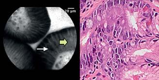 In normal squamous epithelium, two pcle images are shown as well as standard histology with hematoxylin and eosin (H&E).