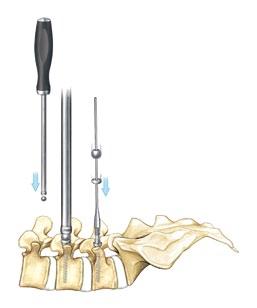 Pedicle Screw Implant Guide Securely fixed to screws facilitate implant delivery for true MIS benefits.