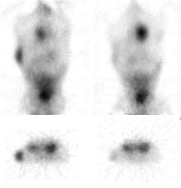 MicroPET images obtained 3 hours post injection with 68 Ga- F(ab) 2 -erceptin in a