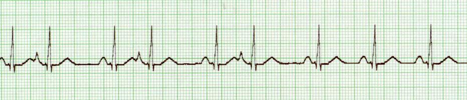 Premature Atrial Contractions (PAC) normal excessive use of caffeine, tobacco, or alcohol CHF Myocardial ischemia or injury Hypokalemia, Dig toxicity