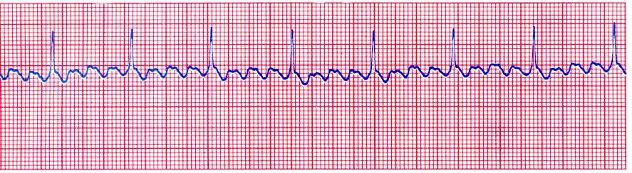 20 second; different from Sinus P:qRs = 1:1 PAC = Atrial Flutter ischemic heart disease Acute MI Dig Toxicity Mitral or Tricuspid valve disease Pulmonary