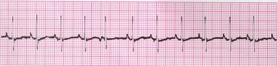 Paroxysmal Atrial Tachycardia Same as PACs Rate: usually 160-220 Rhythm: Regular P waves: differ in shape from Sinus Ps; usually difficult to