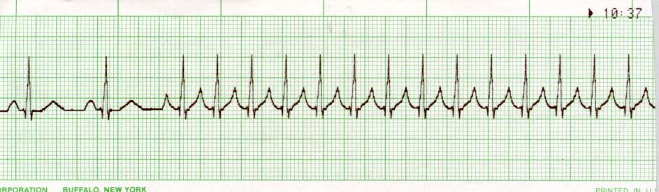 initiated by a PAC Premature Junctional Contraction (PJC) Same as PACs Rate: usually < 100, dependant on the underlying rhythm Rhythm: