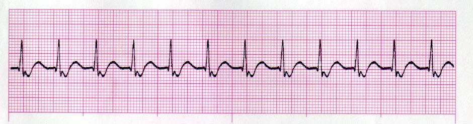 (accelerated) Rhythm: Regular P waves: Inverted before or after qrs or not visible PR interval: < 0.