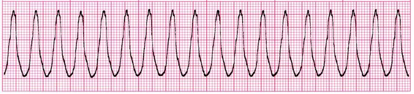 Ventricular Tachycardia Same as PVCs R on T Phenomenon Rate: > 100 per minute and usually not > 220 Rhythm: Usually regular P Waves: P waves or if present, not