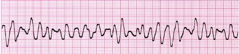 12 sec), bizarre ST/T wave: Opposite direction of qrs A group of three PVCs in a row or more at a rate greater than 100/ minute or more constitutes Ventricular