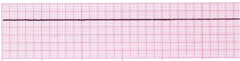 12 sec, notched, bizarre appearance ST/T : Opposite direction of qrs Rate > 40 to 100 = Accelerated