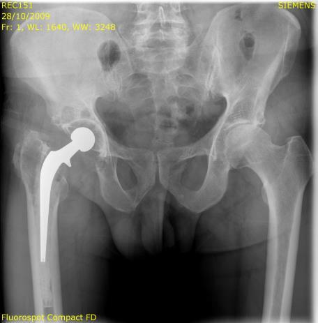 Rec177(right hip) presented massive osteolysis behind the cup There were also some cases with massive osteolysis around the stem (Figure 15).
