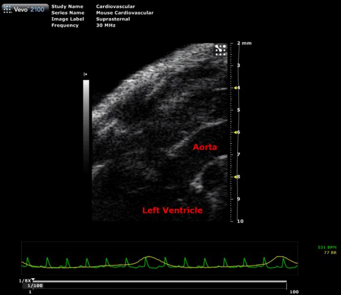 Systolic Function Assessed with PW Doppler Mode Place the