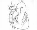 A pulmonary vascular resistance of 8 Woods units per