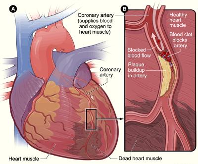 Heart With Muscle Damage and a Blocked Artery Figure A shows a heart with dead heart muscle caused by a heart attack.