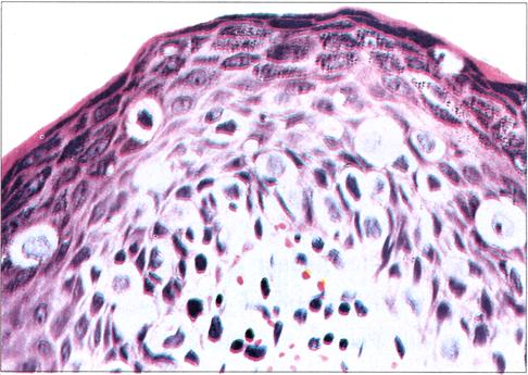 Paget's disease of the breast / Mingtian Yang et al 237 clinicopathological manifestations and treatment outcome of all patients were analyzed to explore the main factors that influence prognosis, so