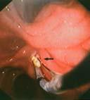 76 94 % 5 % 37 inmoeller 1995 74 74 % - 3-12 ahsin 1997 30 90 % 10 % 16 Rösch 2002 1211 66 % 13 % 60 Endoscopic treatment induces short term pain relief in at least 2/3 of cases.