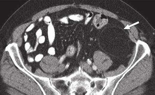 Imaging of Liposarcoma skeletal liposarcoma with radiologic-pathologic correlation. RadioGraphics 2005; 25:1371 1395 6. Fletcher D, Unni K, Mertens F. Liposarcoma of bone.