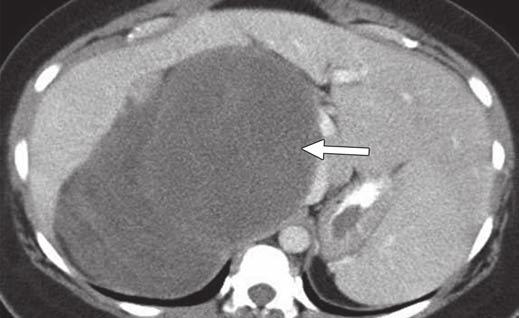 O Regan et al. Fig. 4 51-year-old woman who presented with abdominal mass.