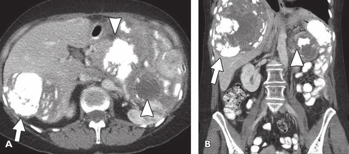 A, Axial CT image of abdomen and pelvis at presentation shows predominantly calcified mass (arrow) surrounding aortic bifurcation.