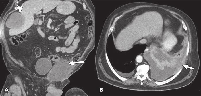 O Regan et al. Fig. 9 82-year-old man with history of resected left inguinal dedifferentiated liposarcoma 13 years previously who presented with new left lower abdominal wall mass.