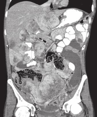 (arrowhead). B, Chest CT image shows extensive left pleural metastasis evidenced by nodular pleural thickening and enhancement (arrow). Fig.